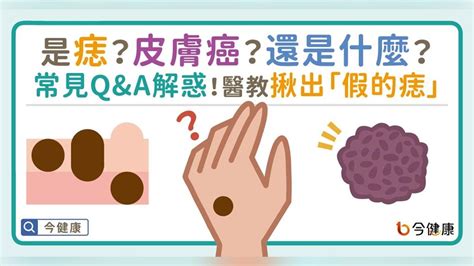 為什麼會長黑痣|是痣？皮膚癌？還是什麼？常見Q&A解惑！醫教揪出「。